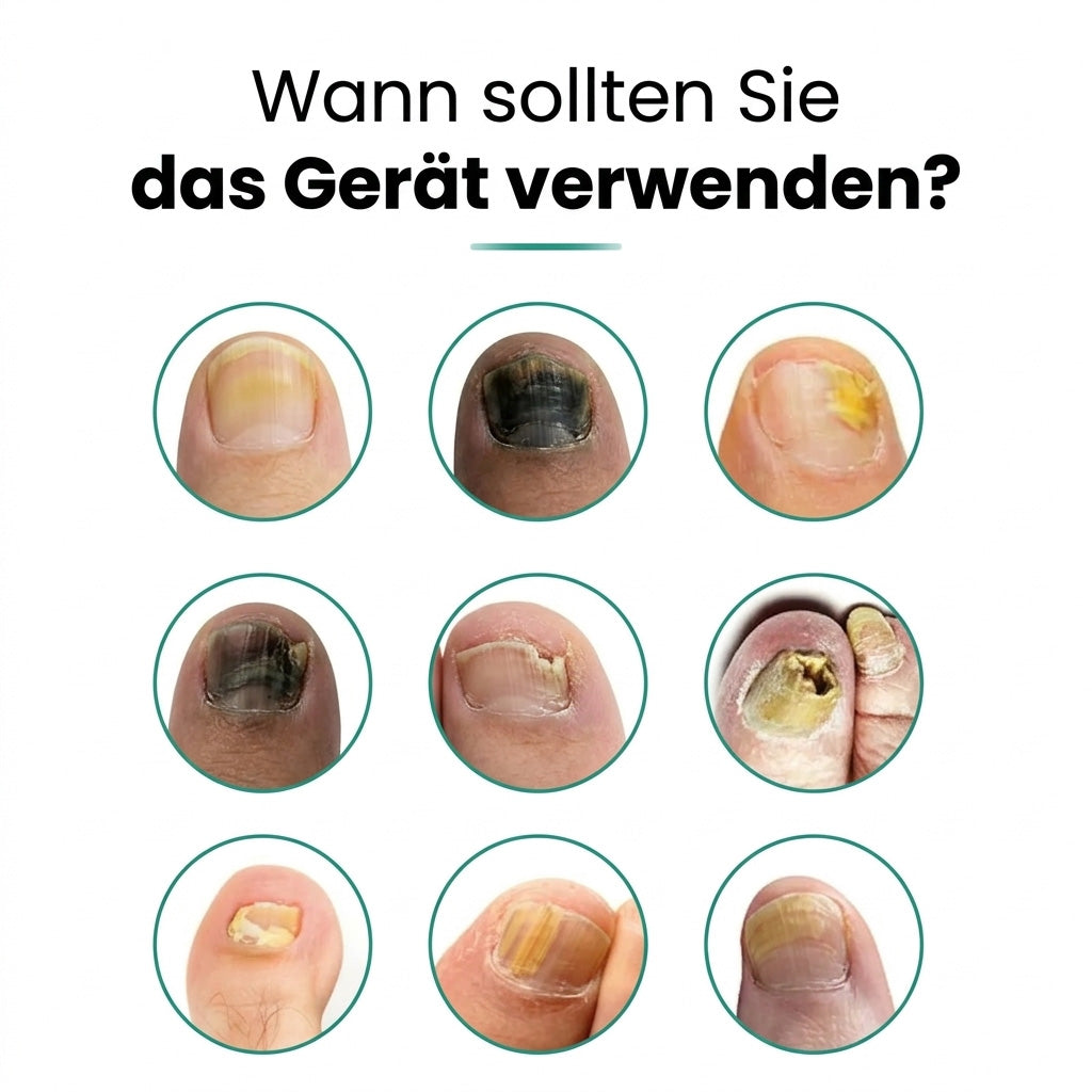 NagelRein – Das Blaulicht-Gerät, das Nagelpilz an der Wurzel bekämpft