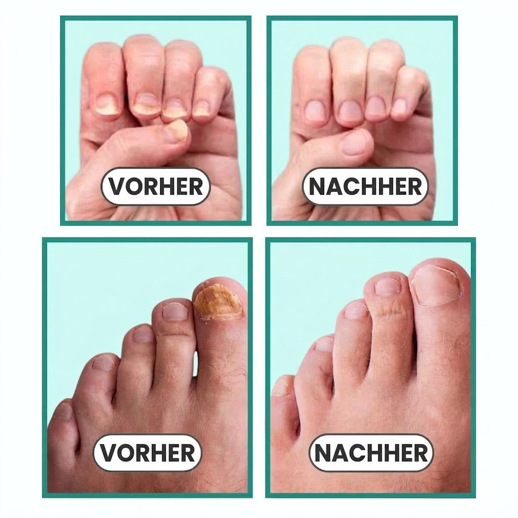NagelRein – Das Blaulicht-Gerät, das Nagelpilz an der Wurzel bekämpft
