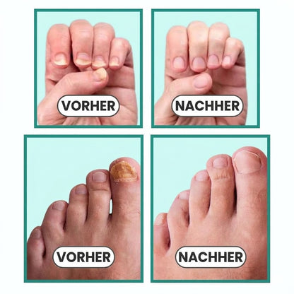 NagelRein – Das Blaulicht-Gerät, das Nagelpilz an der Wurzel bekämpft